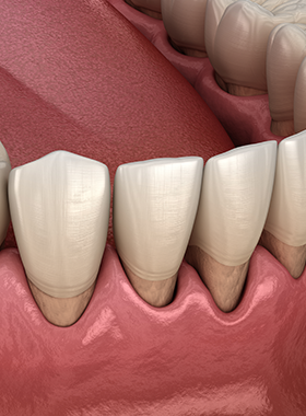 歯周外科処置